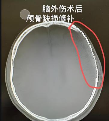 顱骨修補(bǔ)重建系統(tǒng)廠家
