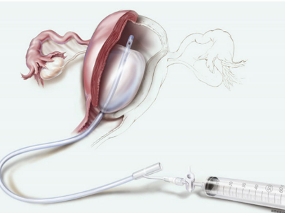 產(chǎn)后止血球囊j-sosr-100500代理