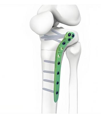 金屬鎖定接骨板系統(tǒng)供應(yīng)商